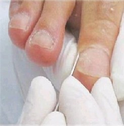 Remoção de Unhas Encravadas